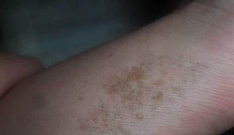 ¿Cómo prevenir y tratar las manchas marrones en la piel? Cuidados