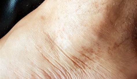 pies masculinos con muchas manchas rojas y cicatrices por picadura de