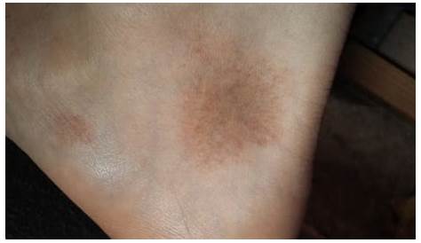 Manchas rojas en el pie, ¿Cuáles son las causas? - Dermatología