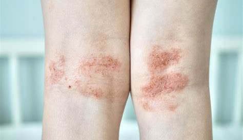 Manchas rojas en las piernas: causas y patogenia.