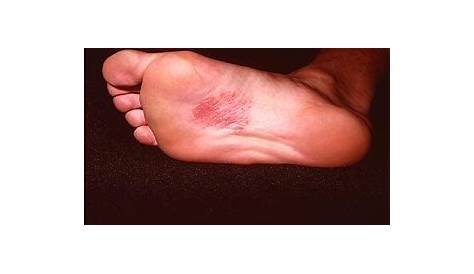 MedlinePlus Enciclopedia Médica: Dermatitis en la planta del pie por níquel