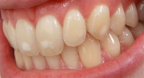 manchas brancas no dente