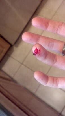 Mandolin Injuries