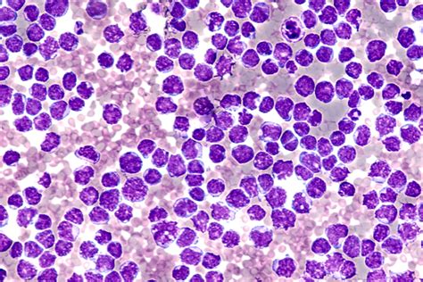 mantle cell lymphoma patient info