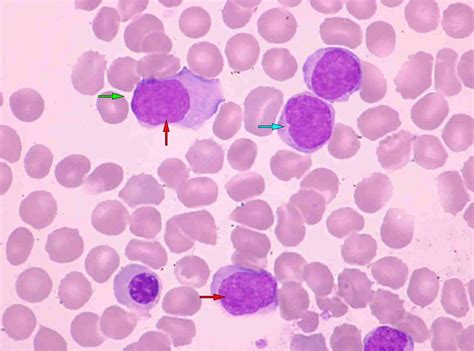 mantle cell lymphoma photos