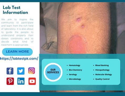 mantoux test cpt code