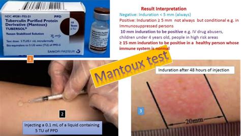 Mantoux Test For Hiv