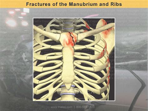 manubrium fracture mortality rate