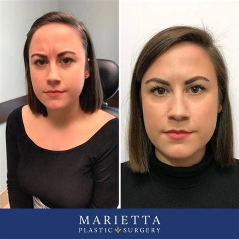 marietta memorial plastic surgery