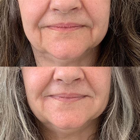 Marionette Lines Nuface