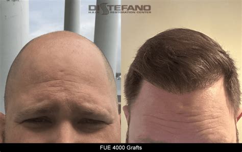 mark distefano hair restoration