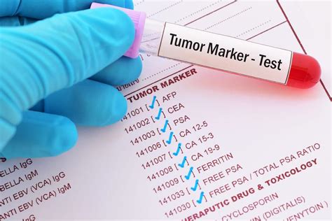 marker tumorali per melanoma