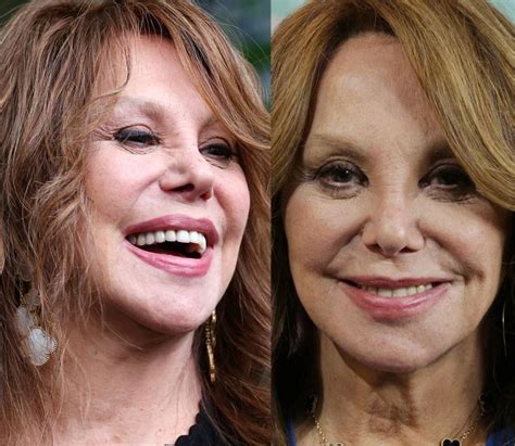 marlo thomas nose