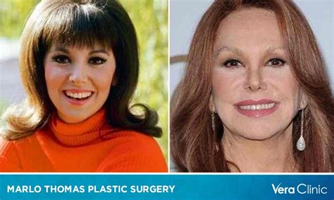 marlow thomas plastic surgery