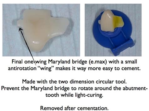Maryland Bridge Cementation