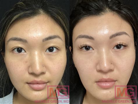 masseter botox