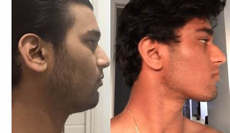 My Jawline Before & After Chewing Mastic Gum Matt Phelps