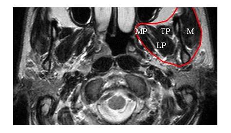 Masticator Muscle Mri MRI Showing An Oval Mass In The Right Masseter