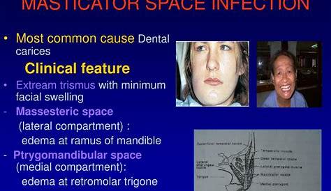 masticator space infections Imaging , clinical findings