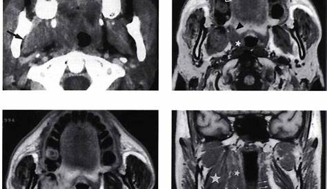 Masticator space infection a coronal CT scan shows
