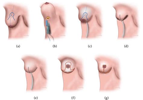 mastopexy augmentation