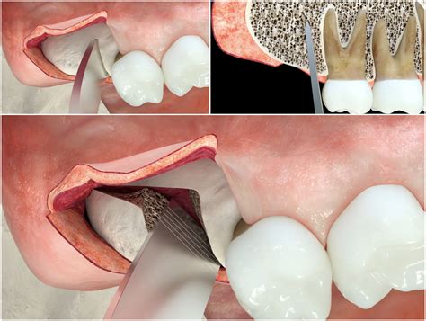 Maxillary Tuberosity Bone Graft