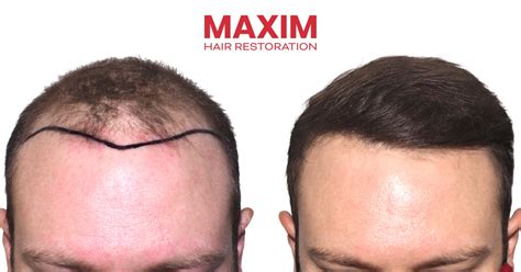 MAXIM Hair Restoration SURGICAL & NONSURGICAL HAIR SOLUTIONS