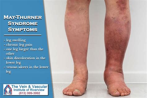 may thurner syndrome symptoms