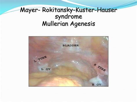 Understanding Mayer Rokitansky Kuster Hauser Syndrome: A Rare Condition