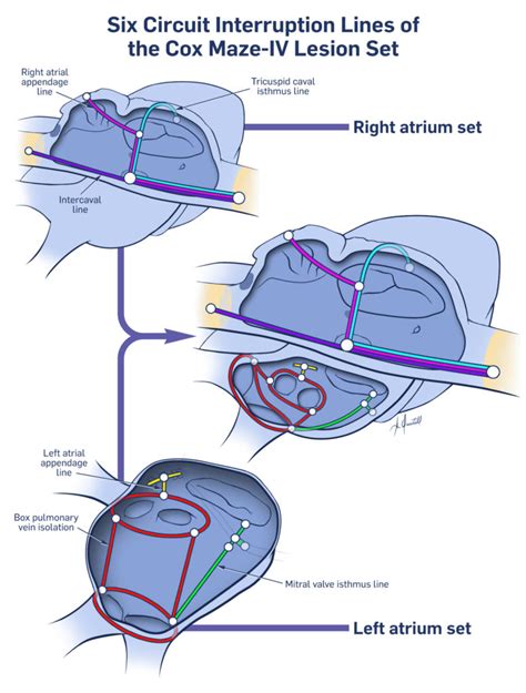 maze procedure for atrial fibrillation