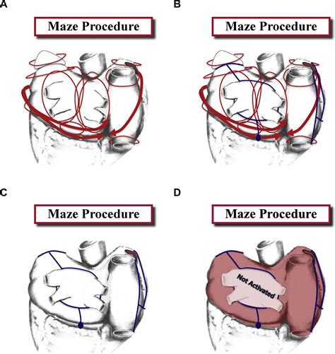 Maze Procedure Vs Modified Maze Procedure