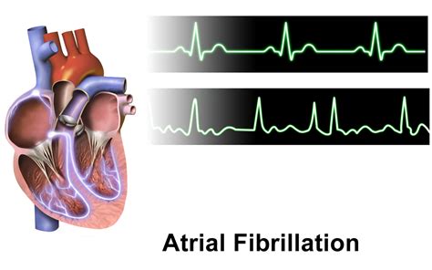 Understanding Atrial Fibrillation: Uncovering the Hidden Meaning Behind This Common Heart Condition