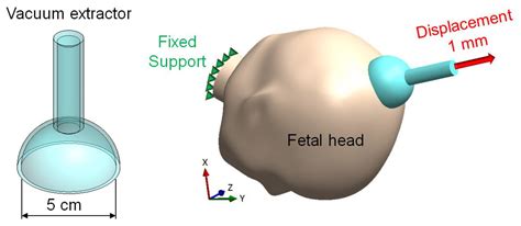 Meaning Of Vacuum Extraction