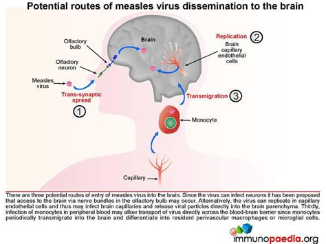 measles encephalitis