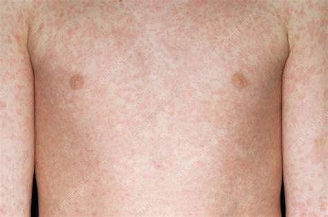 measles like rash in adults