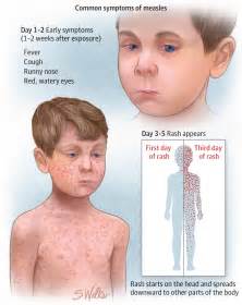 measles rash description and diagnosis
