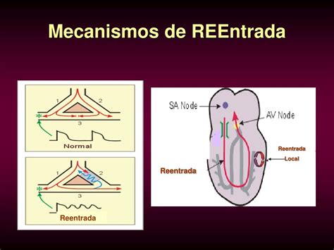 mecanismo de reentrada arritmias