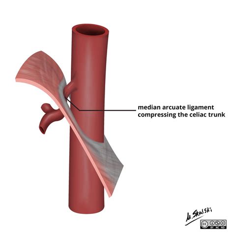 median arcuate ligament syndrome anatomy