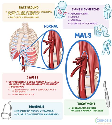 median arcuate ligament syndrome mals