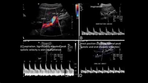 median arcuate ligament syndrome ultrasound
