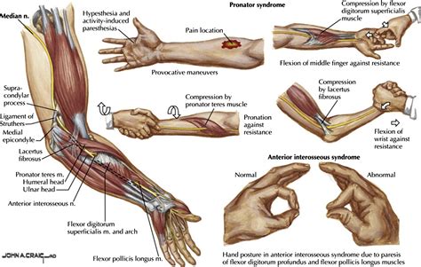 median nerve compression at shoulder