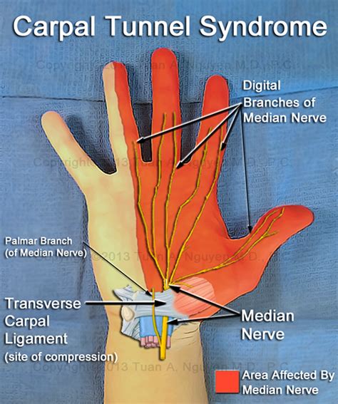 median nerve distribution hand carpal tunnel