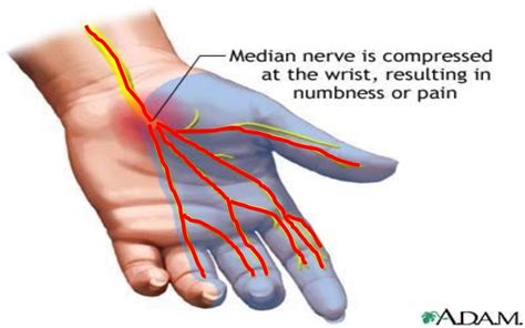 median nerve injury icd 10