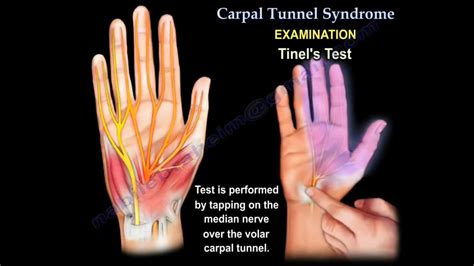 median nerve neuropathy vs carpal tunnel