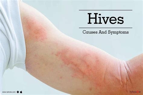 medical conditions that cause hives