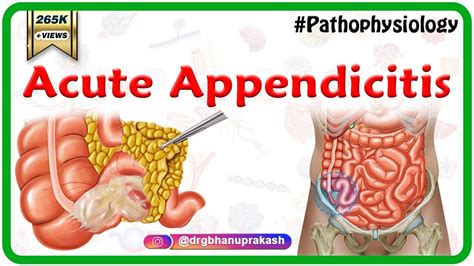 medical definition of acute appendicitis