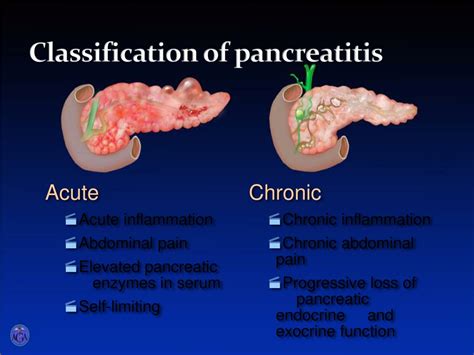 medical definition of pancreatitis