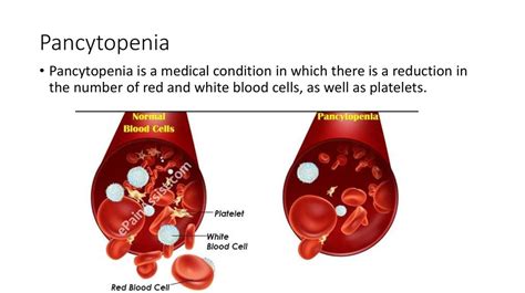 medical definition of pancytopenia