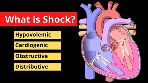 medical definition of shock