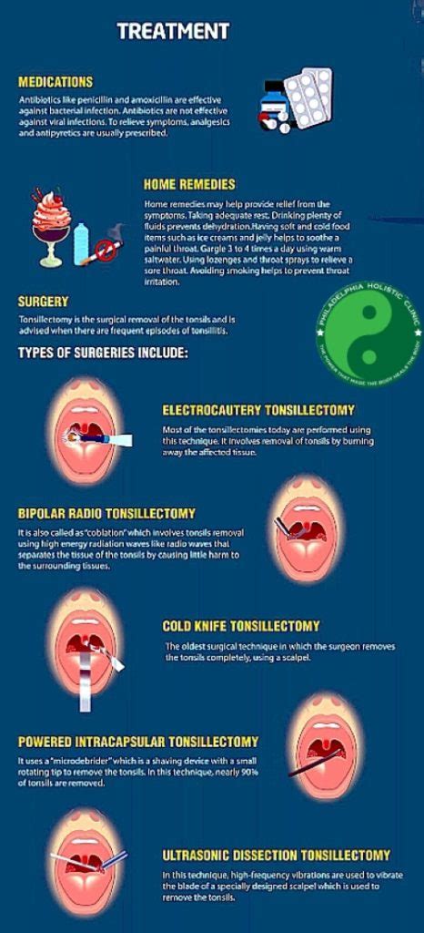 medical management of tonsillitis